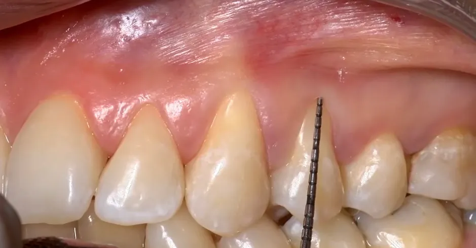Merenje gingivalne recesije parodontalnom sondom